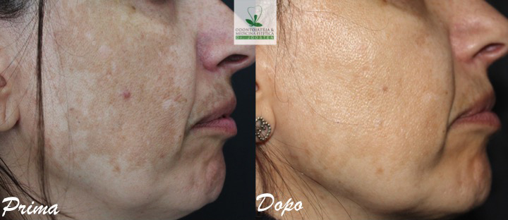 Peeling (1)