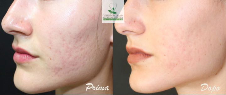 Peeling (2)