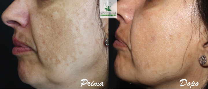 Peeling (3)