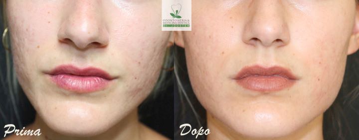 Peeling (4)