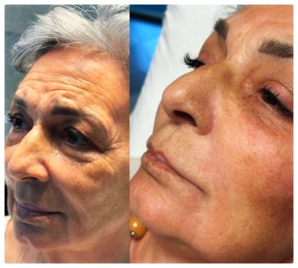 Radiesse total face