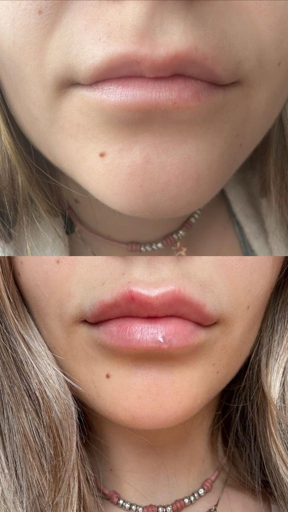 filler labbra