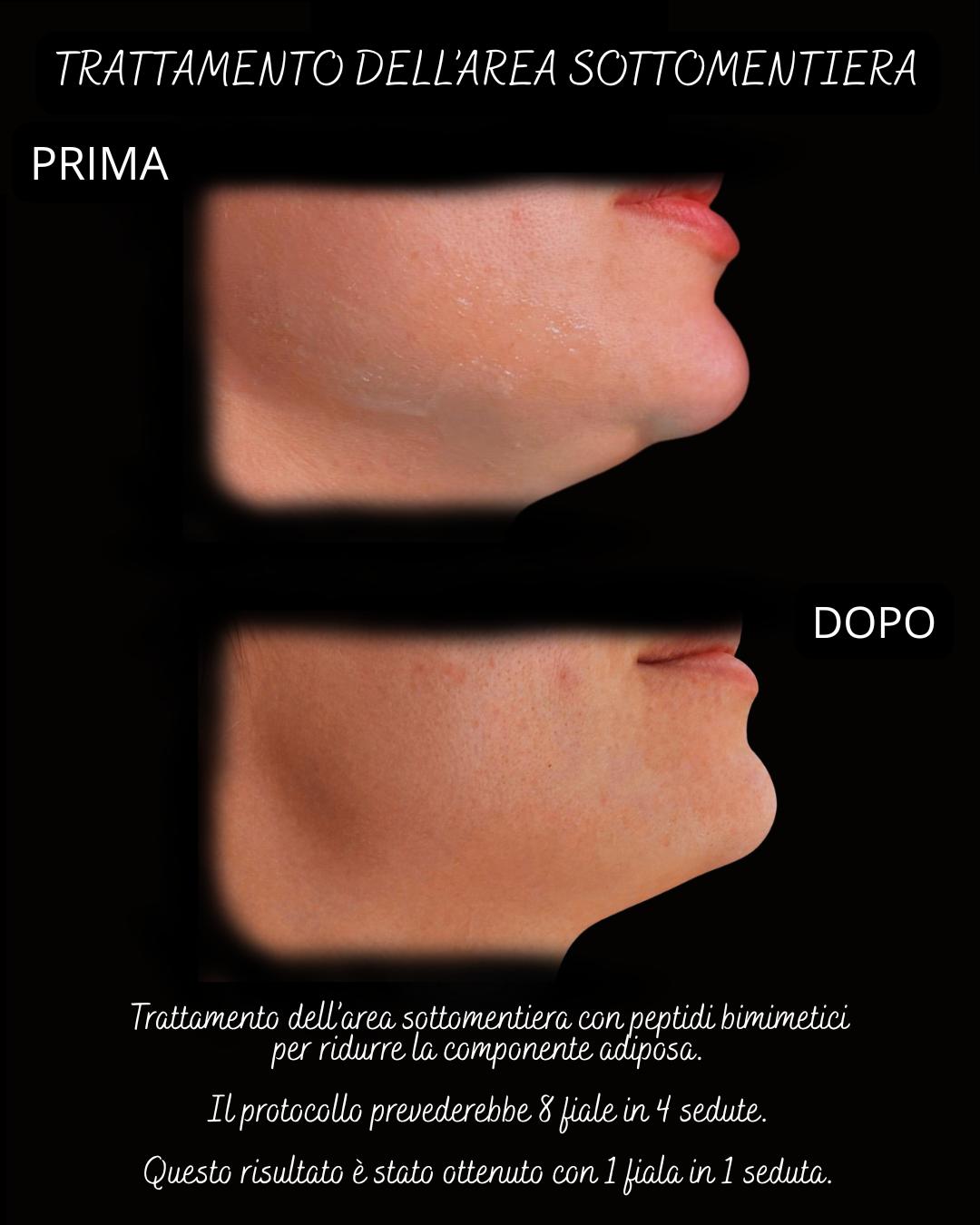 Corso Online Filler Lipolitico con Peptidi Biomimetici
